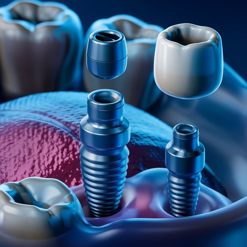 The Most Advanced Dental Implant Technology in Istanbul 2025