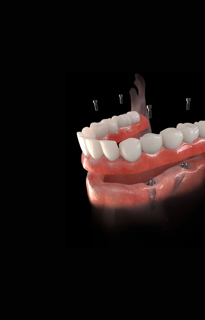 All-on-4 Dental Implants