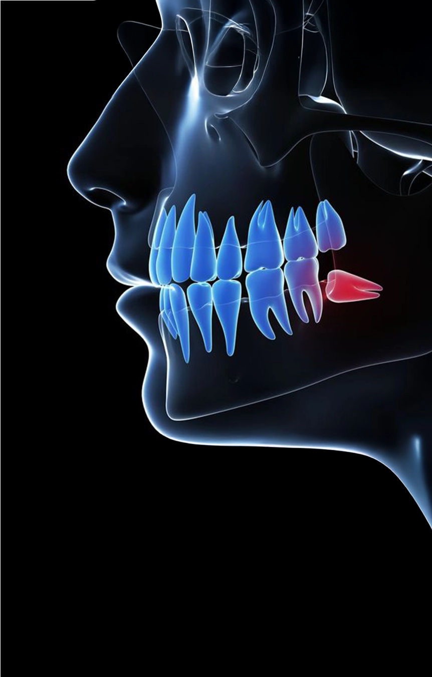 Tooth Extraction | Wisdom Tooth 