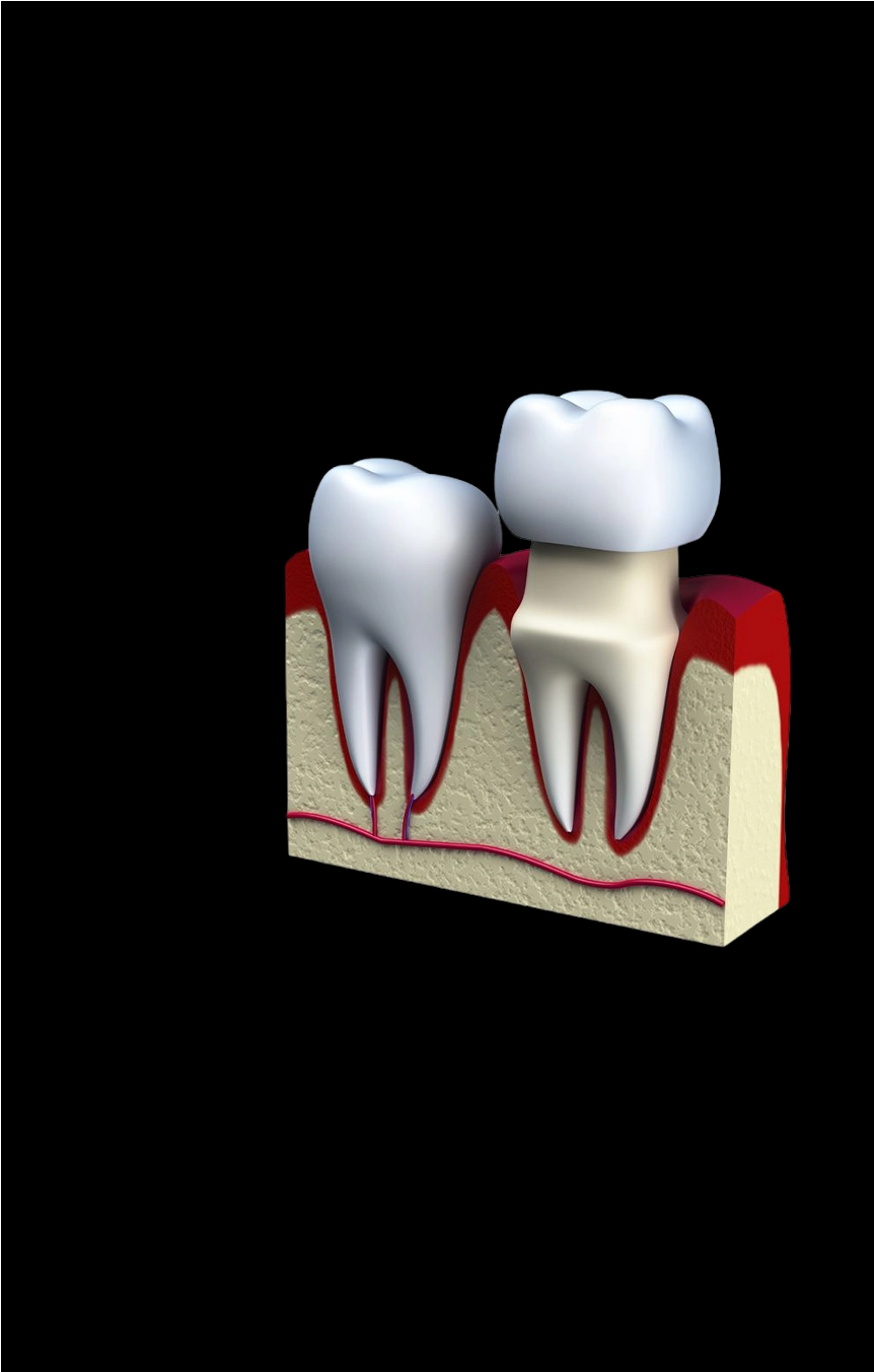  Gingivectomy | Crown Lengthening