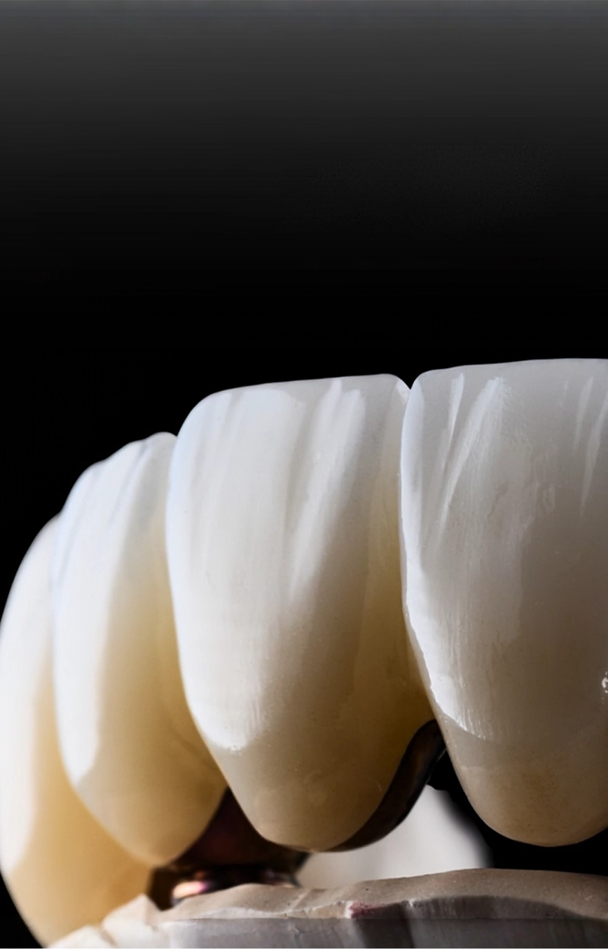 Composite Bonding