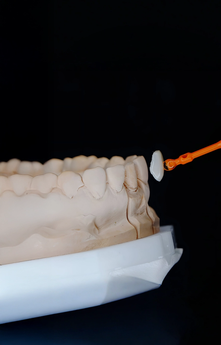 Porcelain Veneers (Emax)