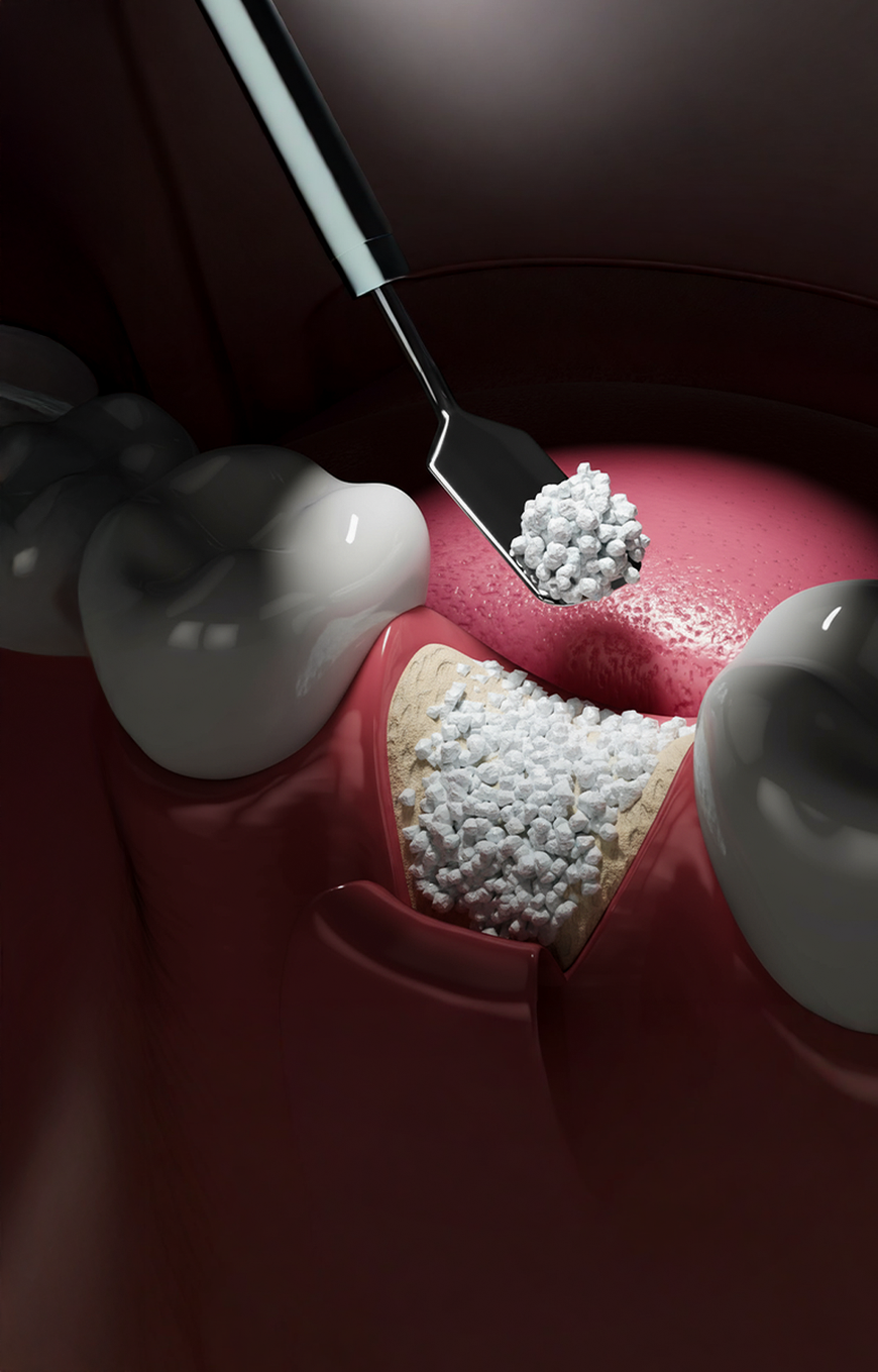 Bone Grafting in Turkey